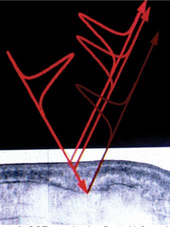 Figure 2. OCT uses back reflected infrared light to provide high res imaging