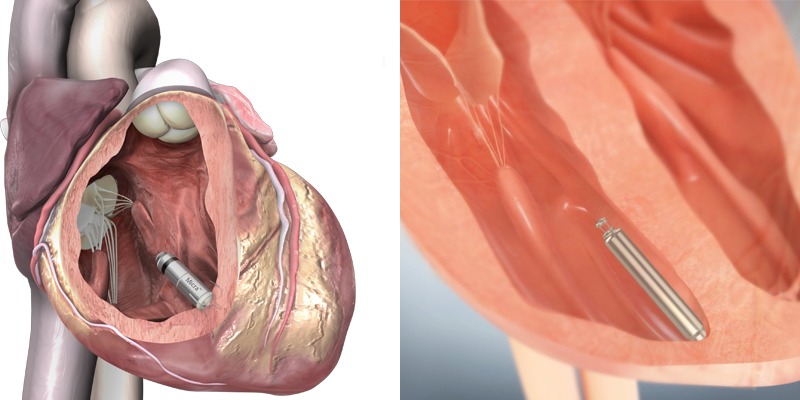 Micra and Nanostim in heart