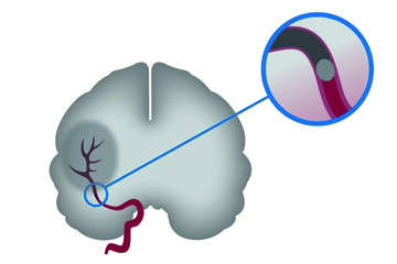 First trial of oral anticoagulant to prevent recurrent stroke due to a blood clot of undetermined source