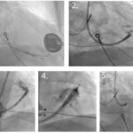 figure-1-ebr-case-report