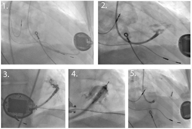 CASE REPORT: WiSE CRT technology ‒ a feasible and effective alternative ...