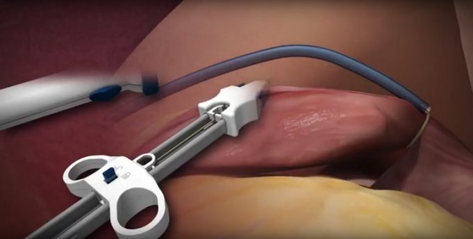 US FDA grants Investigational Device Exemption to Aegis Medical for Sierra ligation system