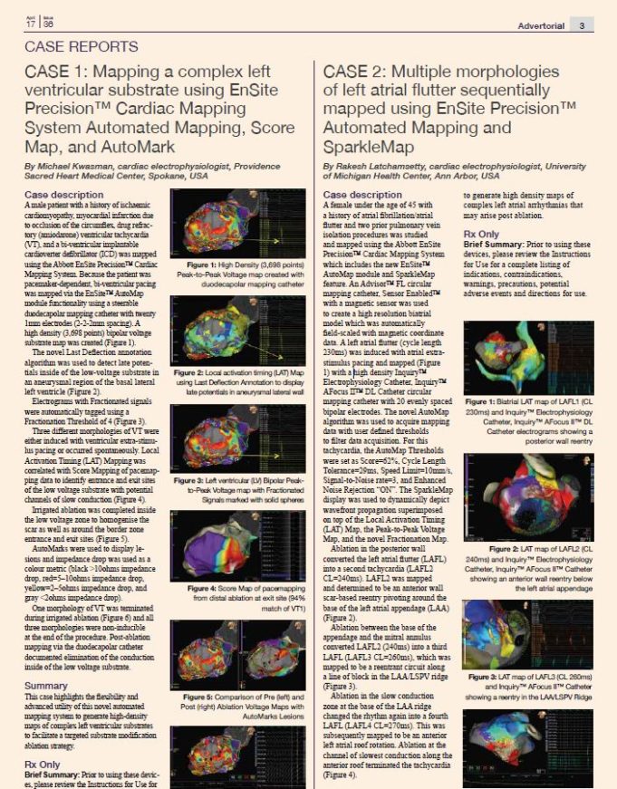 Abbott EnSite Precision™ Cardiac Mapping System ‒ CASE REPORTS
