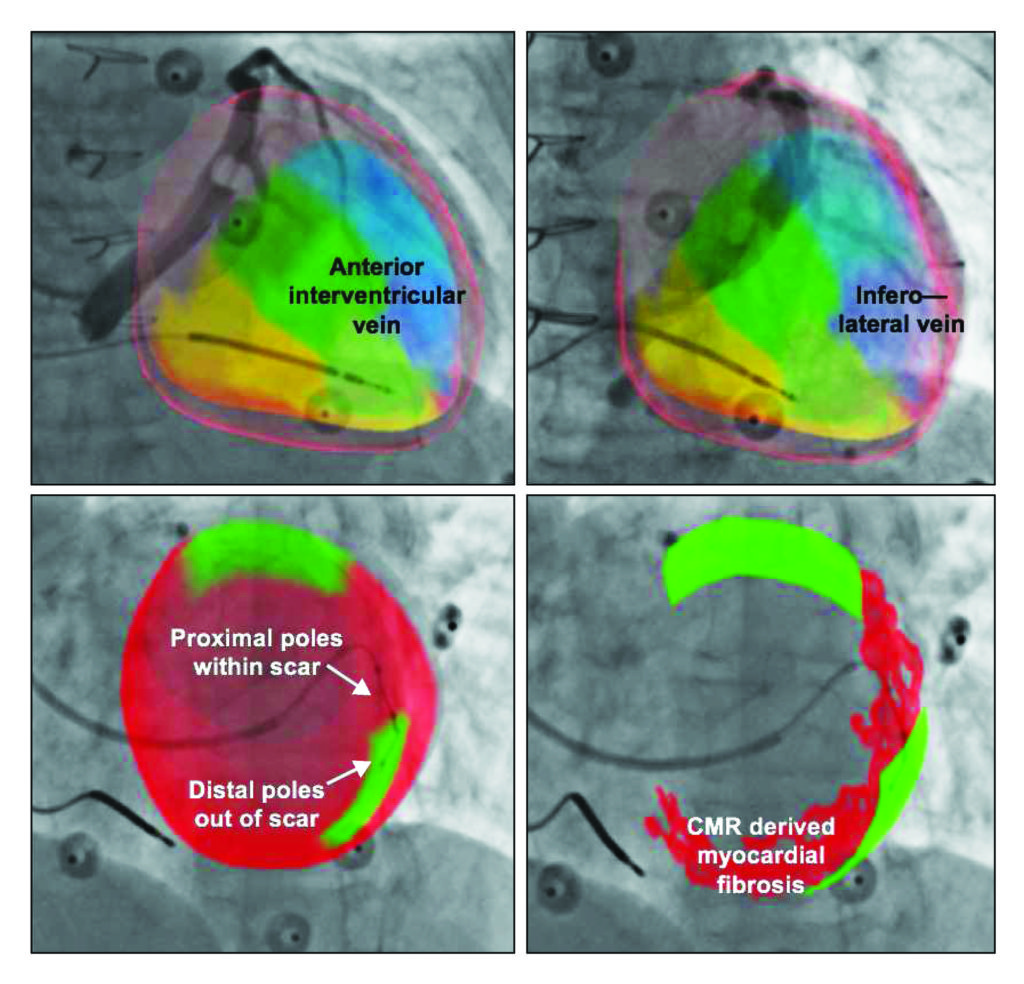 Cardiac Resynchronisation Therapy Guided By Imaging The Next Step For Optimal Left Ventricular