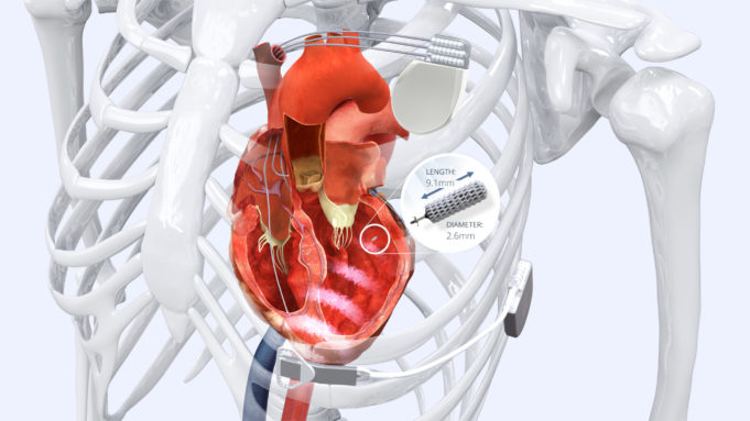 US$50 million raised for SOLVE-CRT study on wireless CRT technology