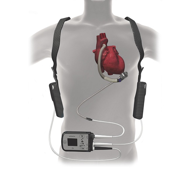 Heart failure: New electric mesh device gives the heart an  electromechanical hug - Medical Design and Outsourcing
