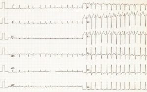 atrial fibrillation