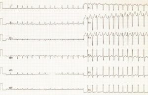 atrial fibrillation