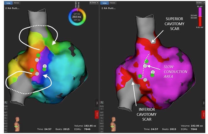High-density electroanatomical map of the tachycardia (lateral view of the right atrium), on RHYTHMIATM mapping system.