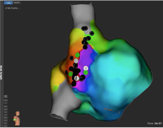 Case report: Usefulness of high resolution mapping with mini-electrodes ...