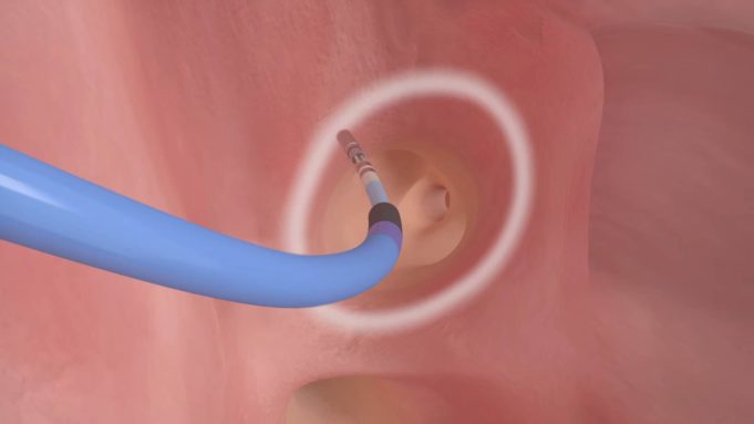 DEEP-guided ablation may enable better treatment of ventricular tachycardia