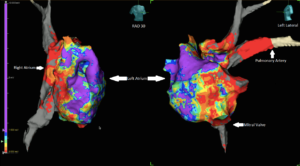 Pre-ablation voltage map in RAO 30 and left lateral. Data collected with Advisor HD Grid with HD Wave voltage presentation.