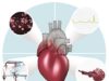 ESC 2019: Guidelines on supraventricular tachycardias underline pivotal role of catheter ablation New ESC guidelines on SVTs