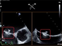 First trial of in-heart micro device for left atrial pressure monitoring launched