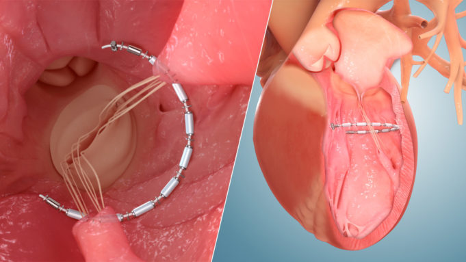 First patient enrolled in European study of AccuCinch ventricular repair system