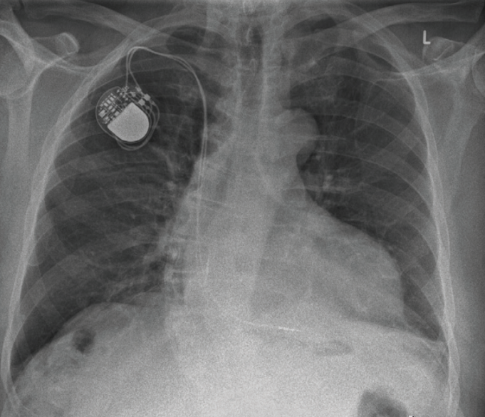 Case report: Successful use of the Evolution RL rotational extraction ...