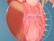 AccuCinch ventricular repair system