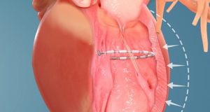 AccuCinch ventricular repair system