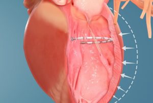 AccuCinch ventricular repair system 