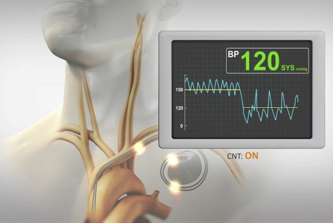 Orchestra BioMed announces positive data for its BackBeat Cardiac Neuromodulation Therapy BackBeat Cardiac Neuromodulation Therapy gets postive data