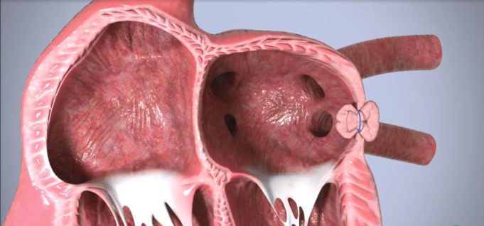 Append Medical completes transcatheter implant-free LAA occlusion procedures