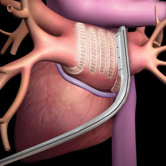 CONVERGE IDE trial results presented at HRS 2020 Science