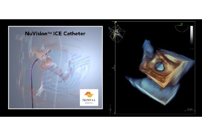 NuVera announces successful first-in-human use of NuVision ICE catheter