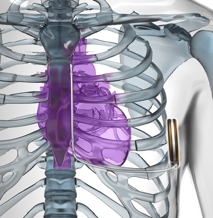 Twin studies demonstrate the evolving S-ICD evidence-base
