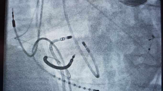 CorSystem announces first use of Bipolar Ablation Adapter