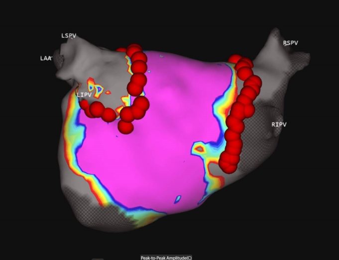 AcQForce PFA-CE study begins for focal PFA therapy to treat atrial fibrillation