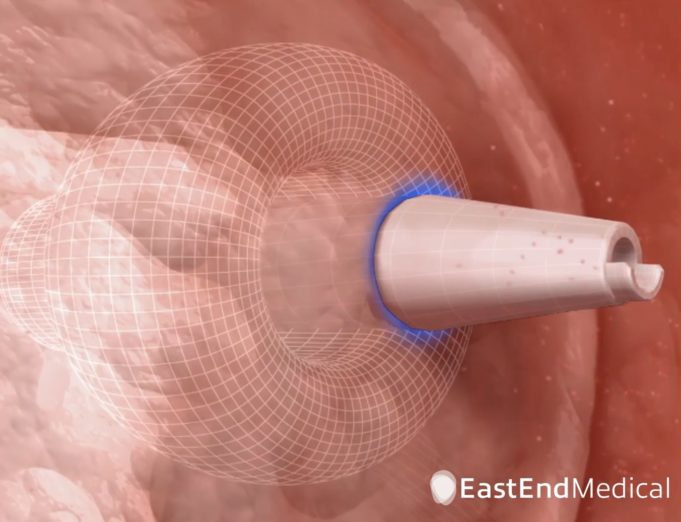 SafeCross transseptal balloon gets first commercial use