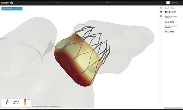 FEops Heartguide receives FDA clearance for LAAO planning capabilities