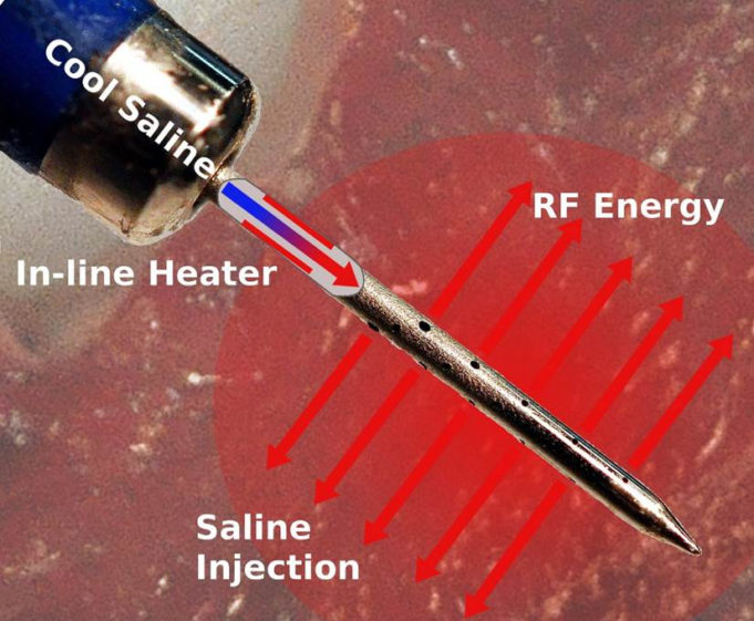 Feasibility study completed using PFA combined with SERF ablation system for VT treatment