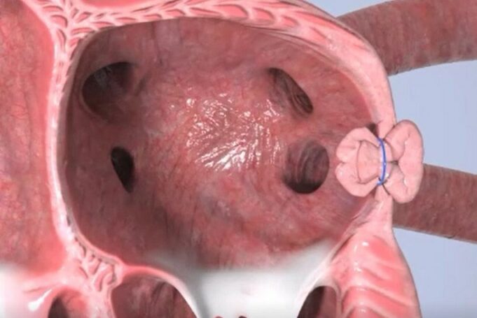 Append Medical raises US$4.35 million in initial closing of extended series A round