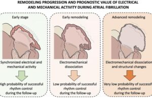 Multidisciplinary research yields new model for assessing atrial remodelling in AF patients
