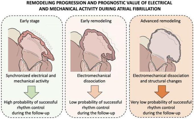 Multidisciplinary research yields new model for assessing atrial remodelling in AF patients