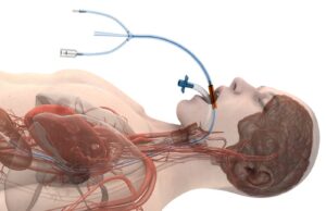 EVERCOOL AF study of oesophageal cooling system enrols its first patient