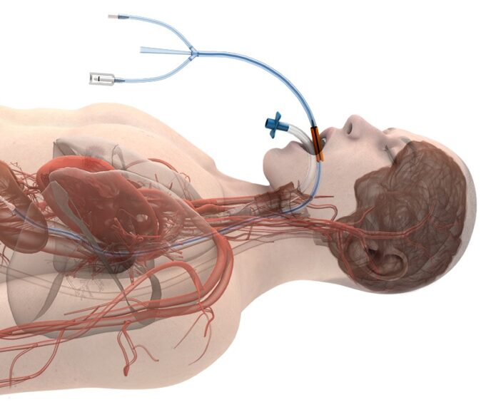 EVERCOOL AF study of oesophageal cooling system enrols its first patient