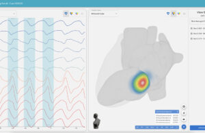 Vektor Medical launches vMap software enhancements