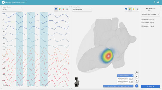 Vektor Medical launches vMap software enhancements