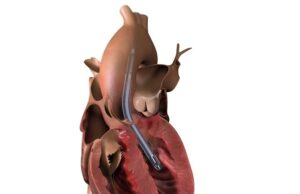 First patient enrolled in RECOVER IV randomised trial of Impella in AMI patients