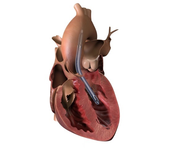 First patient enrolled in RECOVER IV randomised trial of Impella in AMI patients