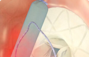 Adona Medical secures financing to initiate clinical use of interatrial shunt device
