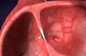 First US heart failure patient receives V-LAP left atrial pressure sensor