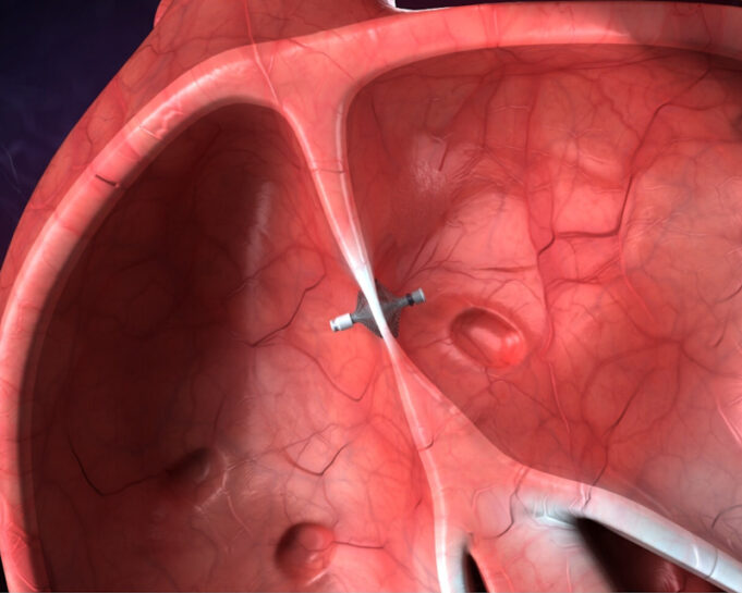 First US heart failure patient receives V-LAP left atrial pressure sensor