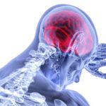 Animated stroke patient featured