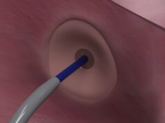 First experience of novel transseptal puncture device shared at STS 2025