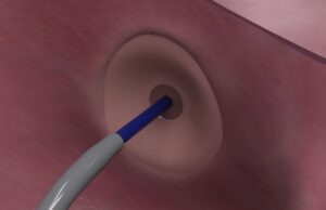First experience of novel transseptal puncture device shared at STS 2025