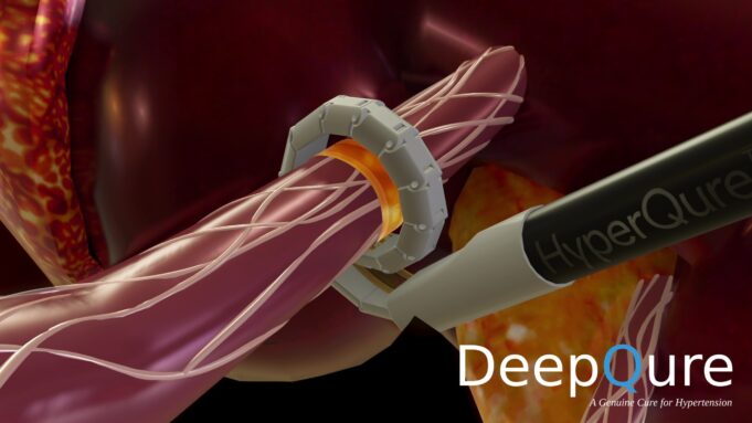 HyperQure extravascular renal denervation system to address AF