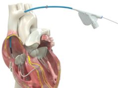 OmniaSecure becomes first defibrillation lead to receive US FDA approval for conduction system pacing